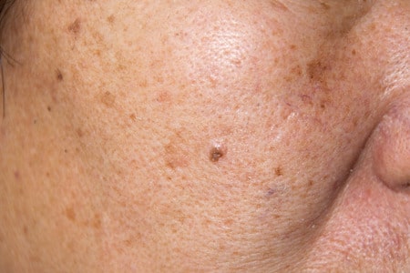 Comment Faire Pour Atténuer Les Taches Brunes Au Visage?